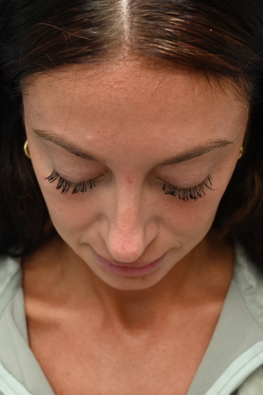 Rhinoplasty Before & After Image