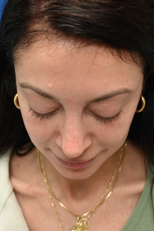 Rhinoplasty Before & After Image