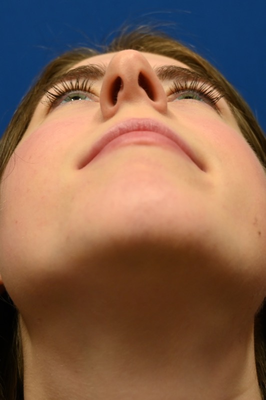 Rhinoplasty Before & After Image