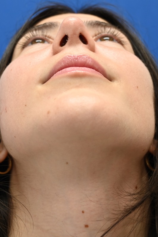 Rhinoplasty Before & After Image