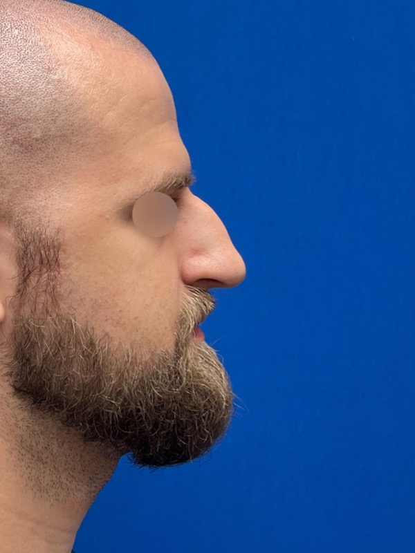 Rhinoplasty Before & After Image
