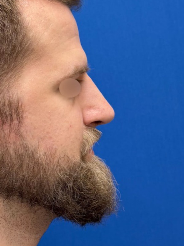 Rhinoplasty Before & After Image