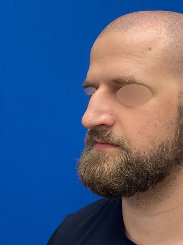 Rhinoplasty Before & After Image