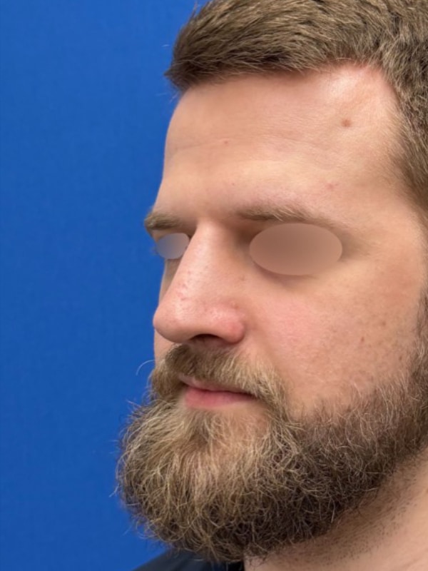 Rhinoplasty Before & After Image