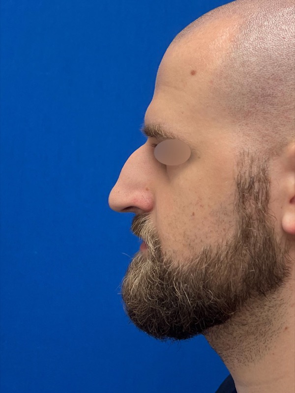 Rhinoplasty Before & After Image