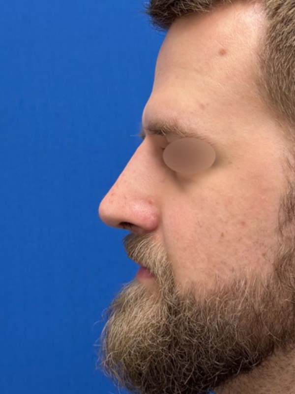 Rhinoplasty Before & After Image