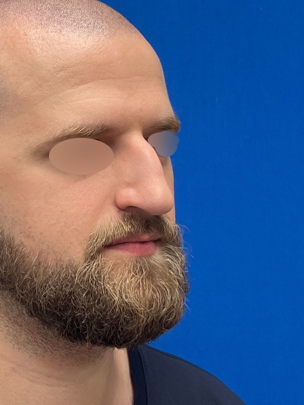 Rhinoplasty Before & After Image