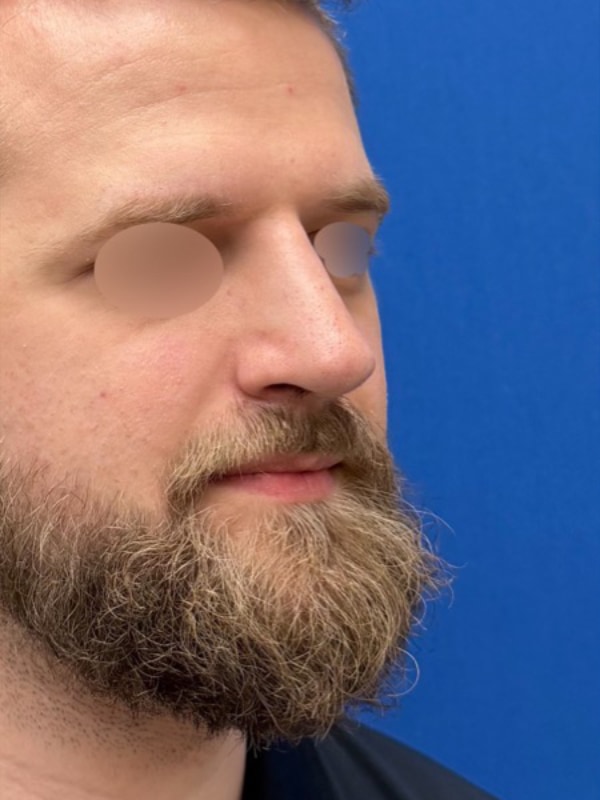 Rhinoplasty Before & After Image