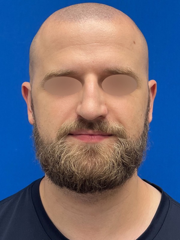 Rhinoplasty Before & After Image