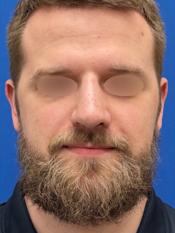 Rhinoplasty Before & After Image
