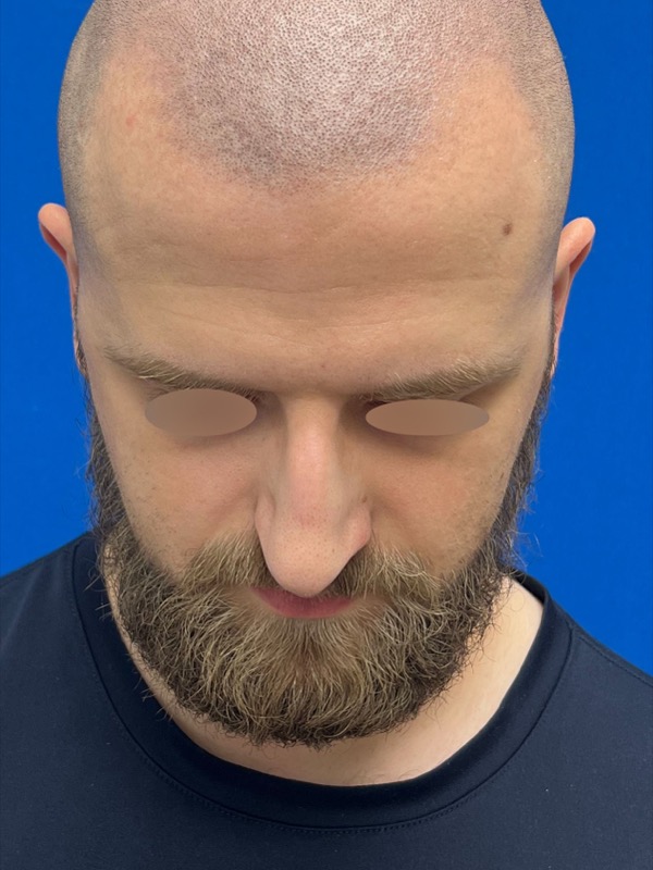 Rhinoplasty Before & After Image