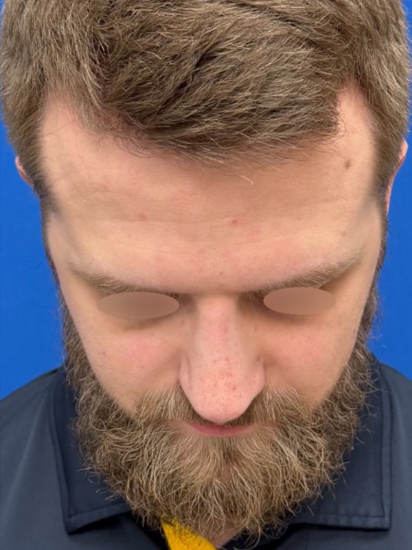 Rhinoplasty Before & After Image