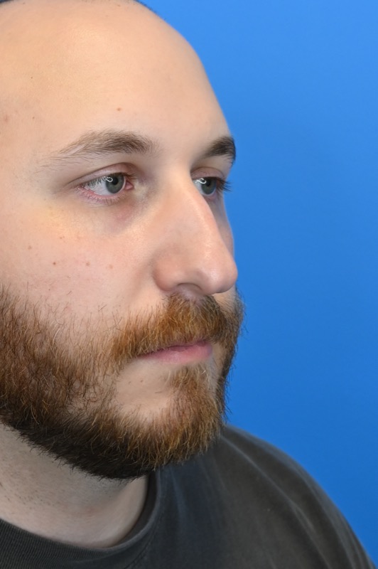 Rhinoplasty Before & After Image