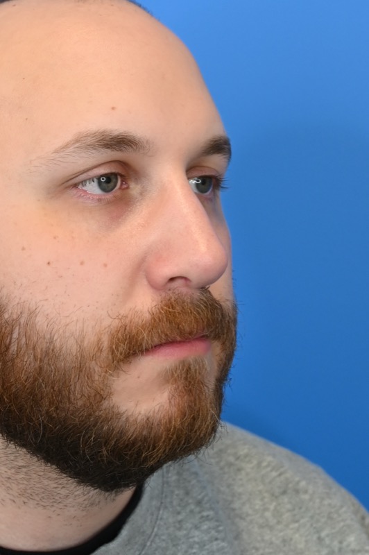 Rhinoplasty Before & After Image