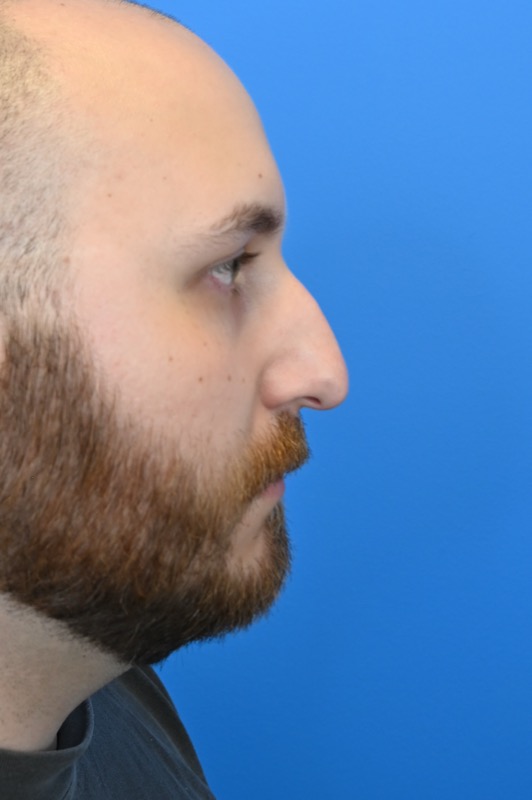 Rhinoplasty Before & After Image