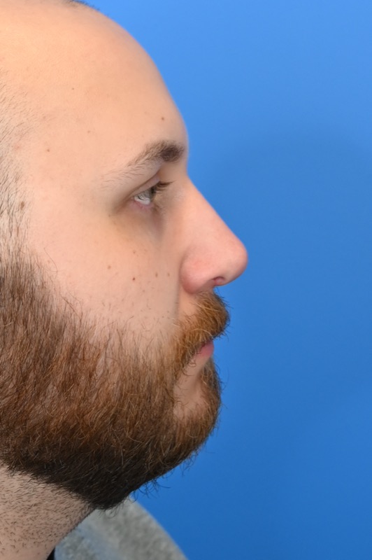 Rhinoplasty Before & After Image