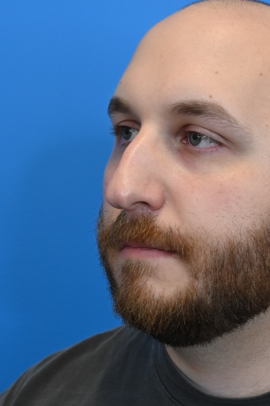Rhinoplasty Before & After Image