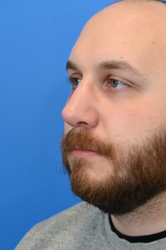 Rhinoplasty Before & After Image