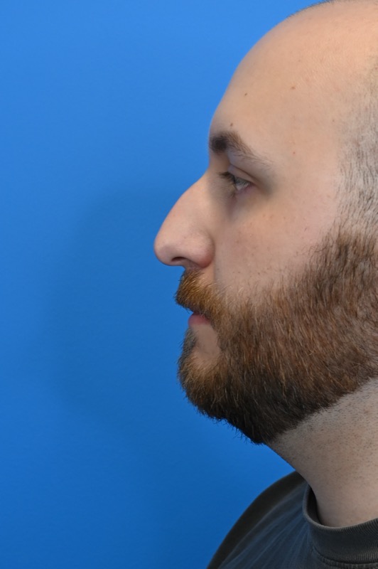 Rhinoplasty Before & After Image