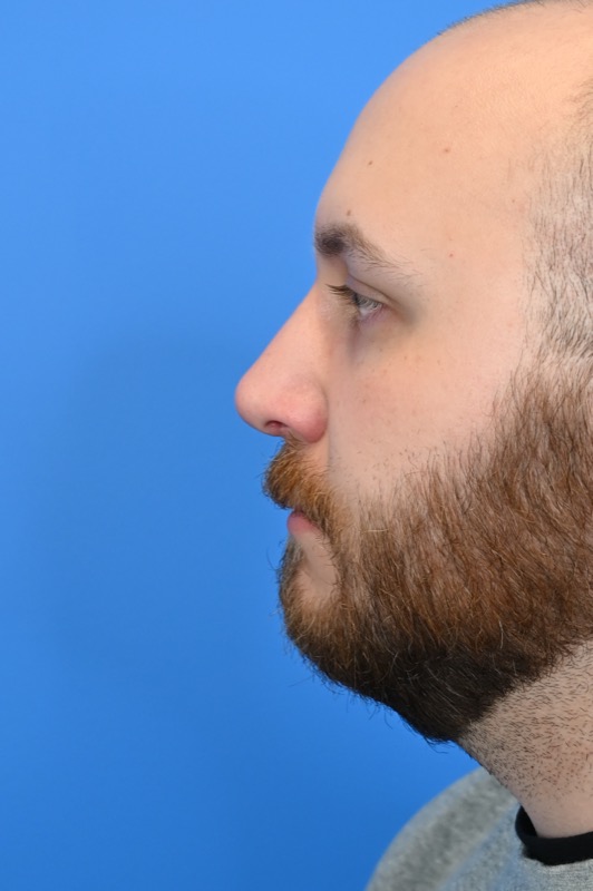 Rhinoplasty Before & After Image