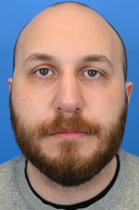 Rhinoplasty Before & After Image