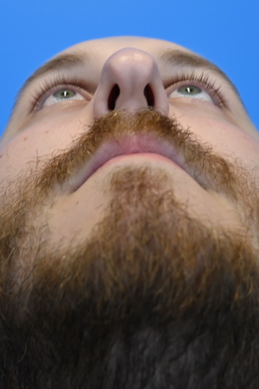 Rhinoplasty Before & After Image