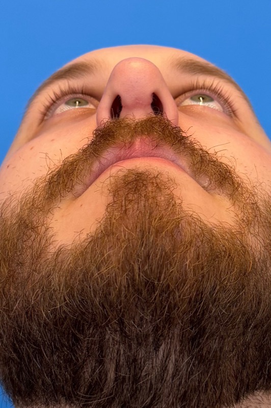 Rhinoplasty Before & After Image