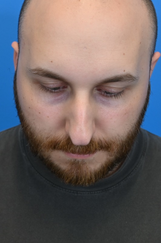 Rhinoplasty Before & After Image