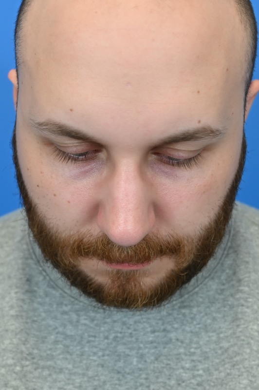 Rhinoplasty Before & After Image