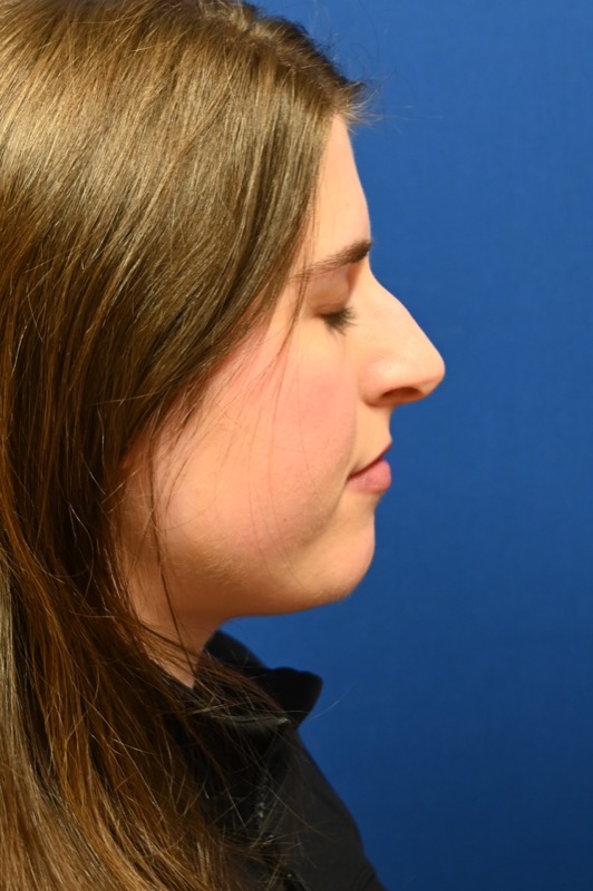 Rhinoplasty Before & After Image