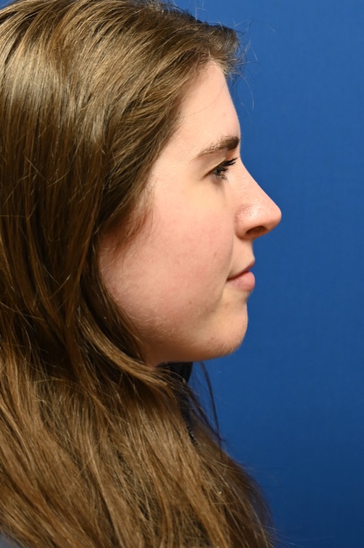 Rhinoplasty Before & After Image