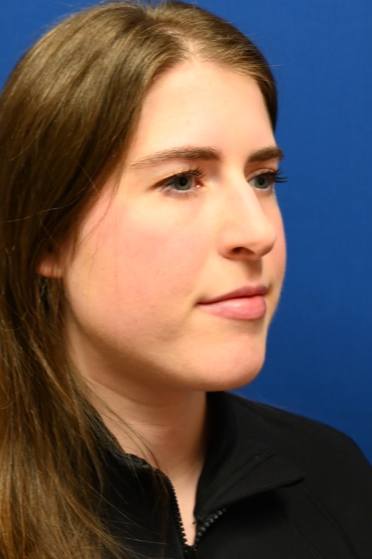 Rhinoplasty Before & After Image