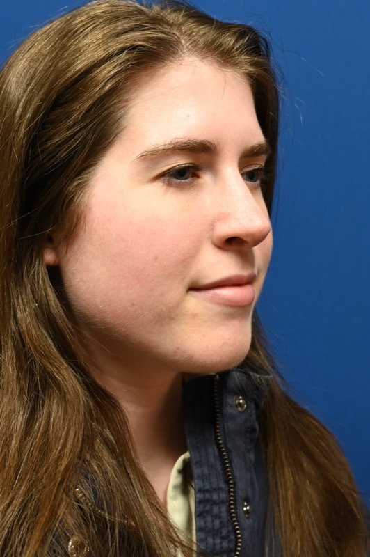 Rhinoplasty Before & After Image