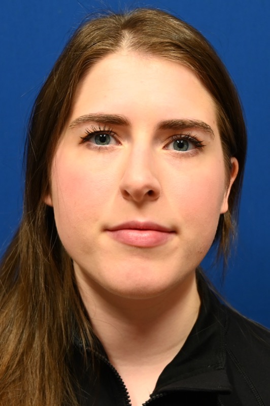 Rhinoplasty Before & After Image