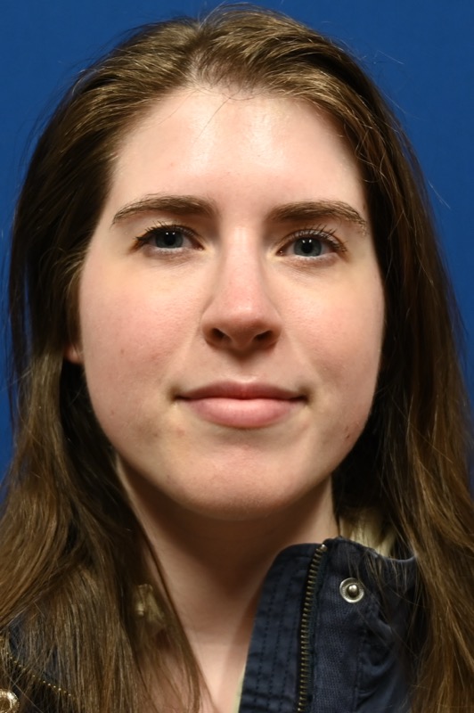 Rhinoplasty Before & After Image