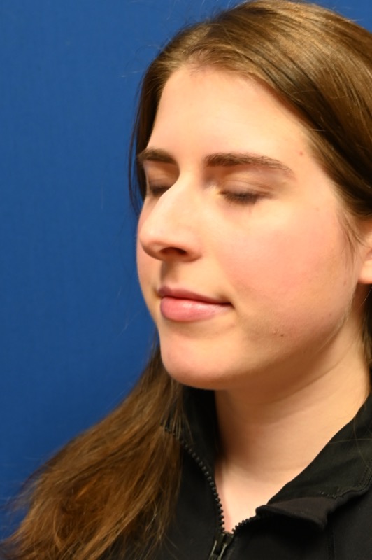 Rhinoplasty Before & After Image