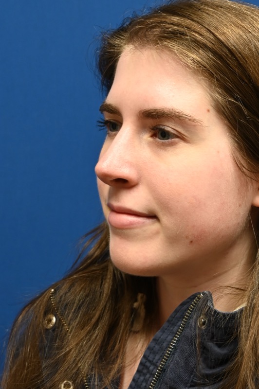 Rhinoplasty Before & After Image
