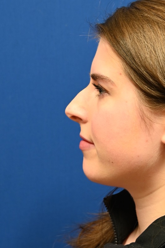 Rhinoplasty Before & After Image