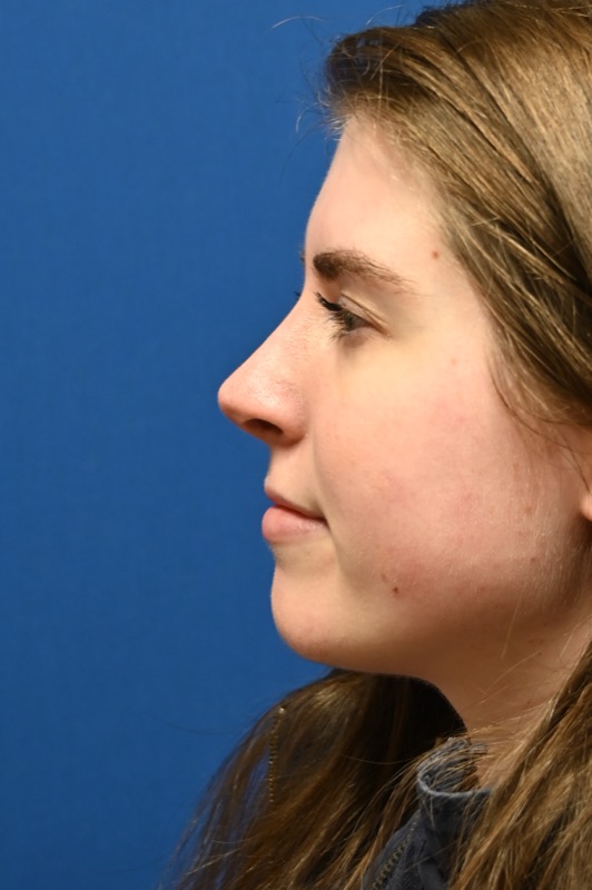 Rhinoplasty Before & After Image