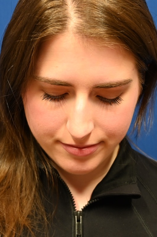 Rhinoplasty Before & After Image