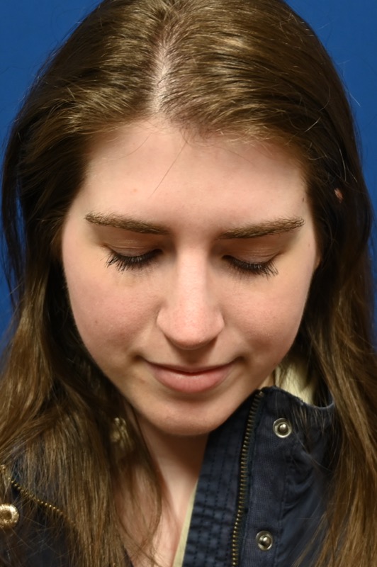 Rhinoplasty Before & After Image