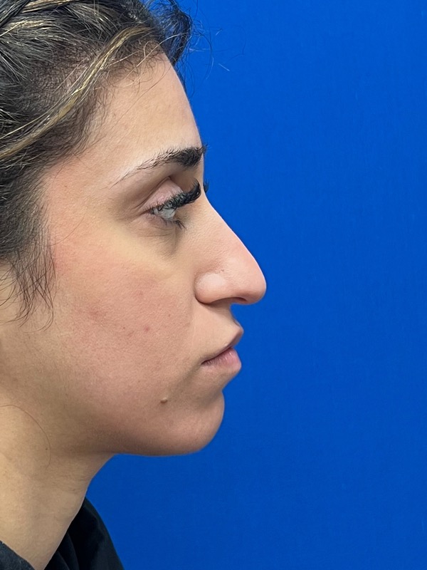 Rhinoplasty Before & After Image