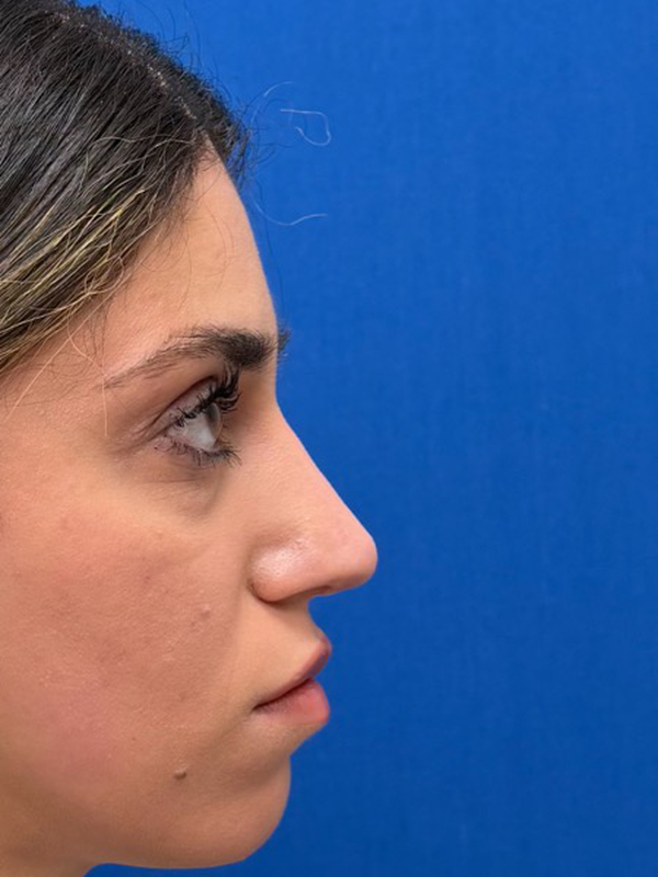 Rhinoplasty Before & After Image