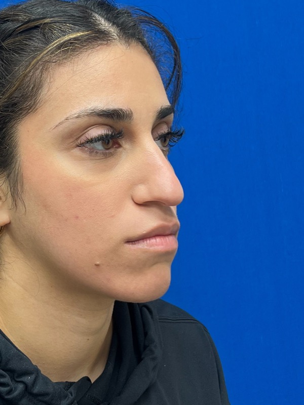 Rhinoplasty Before & After Image