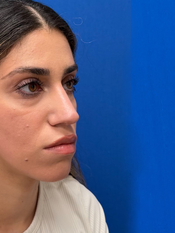 Rhinoplasty Before & After Image