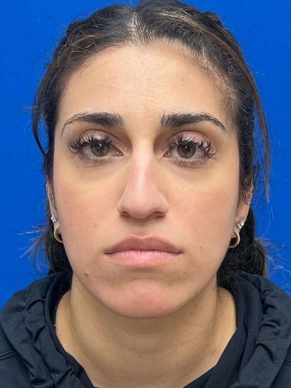 Rhinoplasty Before & After Image