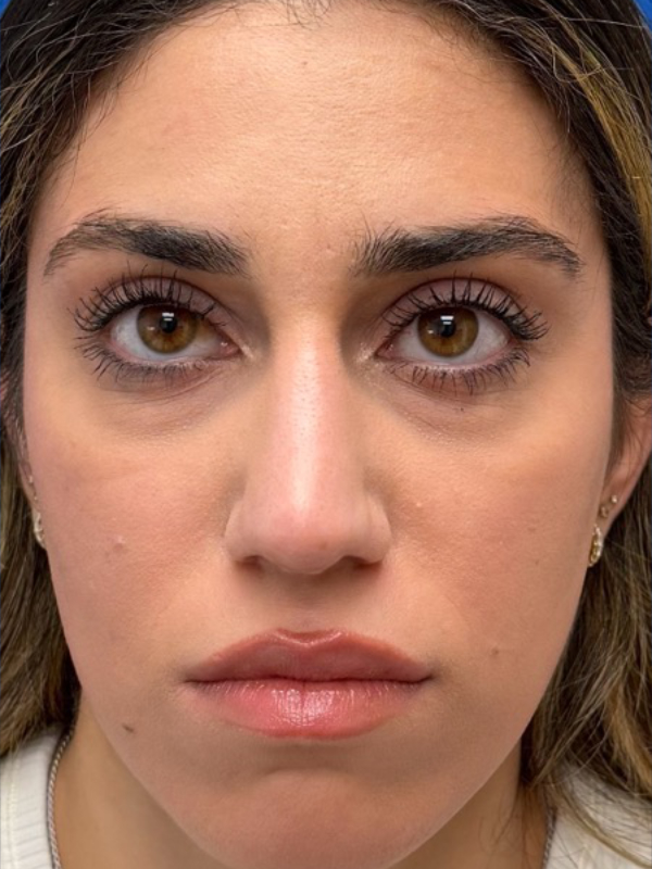 Rhinoplasty Before & After Image