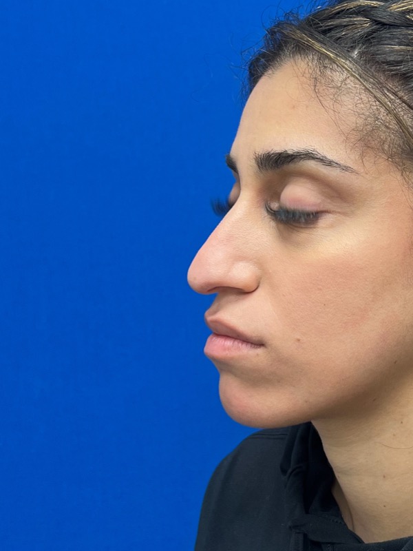 Rhinoplasty Before & After Image