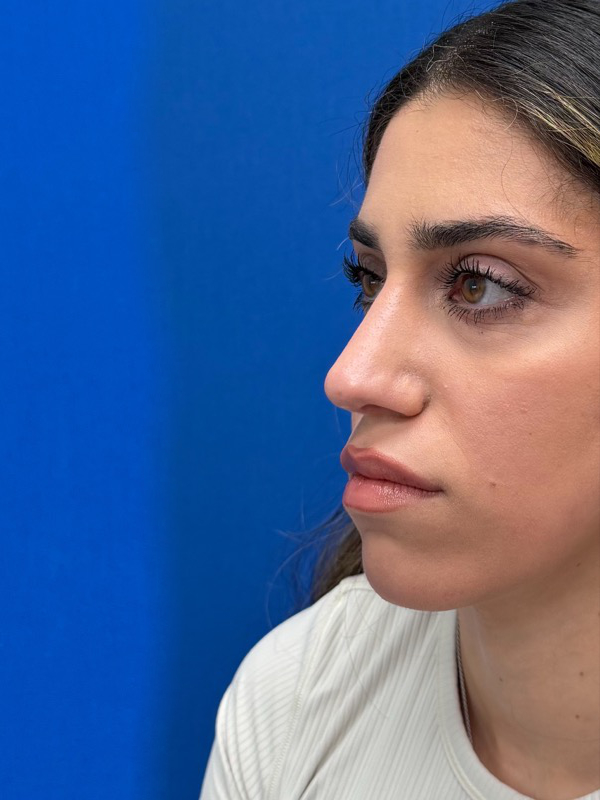 Rhinoplasty Before & After Image
