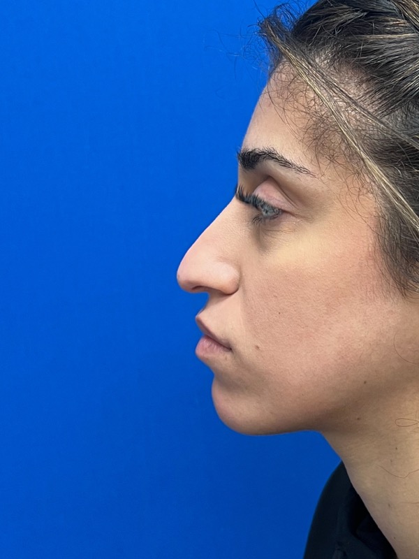Rhinoplasty Before & After Image